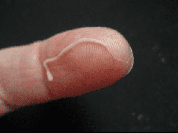 Кременчужанину медики вытащили из пальца 5-ти сантиметрового червяка