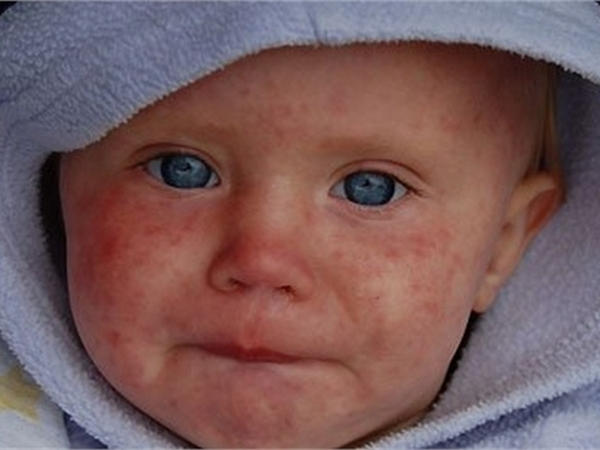 Кременчугские медики настаивают на вакцинации детей против кори