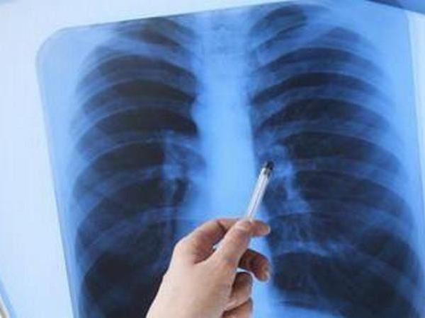 В Кременчуге два человека заболели туберкулезом