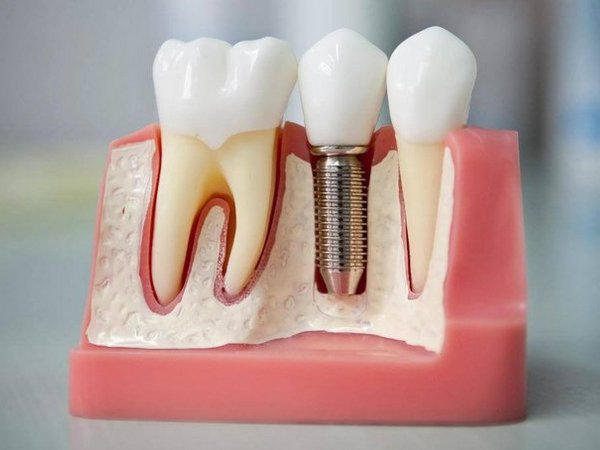 виды зубных имплантов