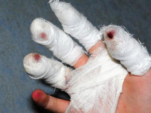 В Кременчуге 10-летней девочке ампутировало петардой часть пальцев