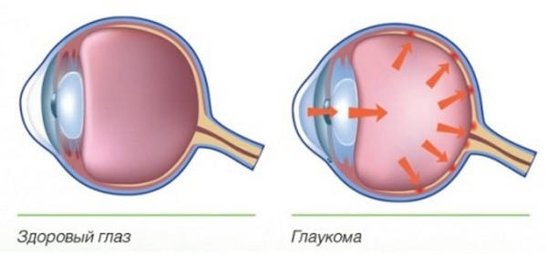 Что такое глаукома глаза