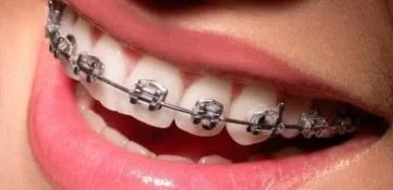 Установка брекетов у взрослых: новый тренд современной ортодонтии